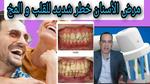 فقدان الأسنان وزيادة خطر الوفاة