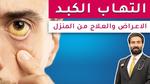 معلومات مهمة حول اليرقان وأسبابه