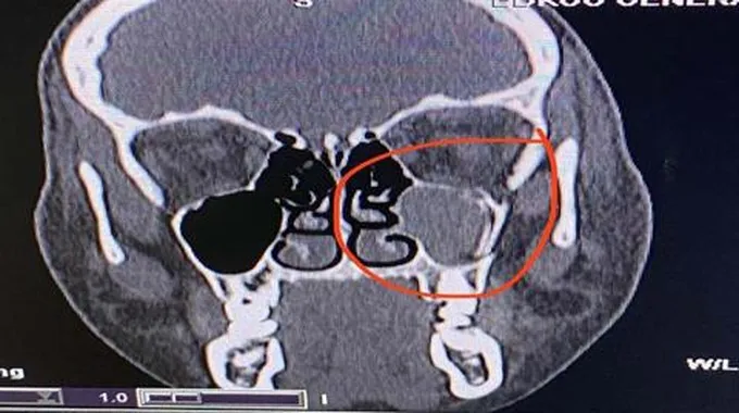 تهشمت جمجمتها.. جراحة تجميلية ناجحة لطفلة سقطت