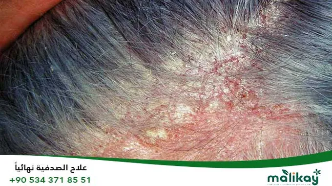 أسباب حكة الرأس وكيفية التعامل معها