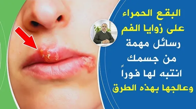أعراض التهاب اللثة وأهميتها لصحة الفم