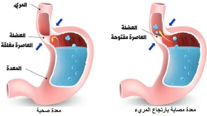 الارتجاع المريئي: الأسباب والوقاية والعلاج