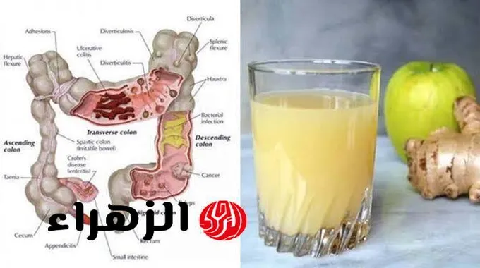 فوائد الزنجبيل في علاج التهاب الأمعاء